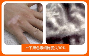 身上皮肤有白点点是什么原因