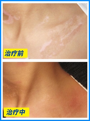 补骨脂擦白斑多久才能见效