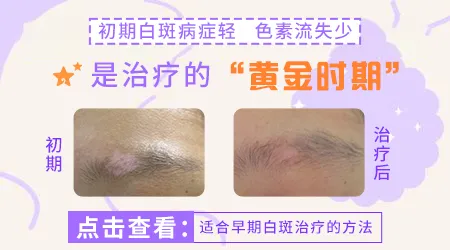 伍德灯下白癜风初期颜色表现