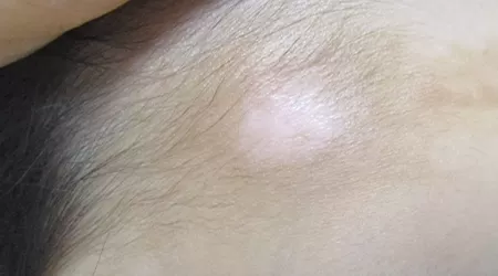 小儿额头有白斑是什么