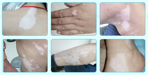 白癜风初期症状照片