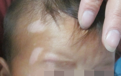 婴儿额头白斑正常图片