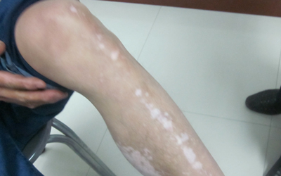 双腿出现白色斑点