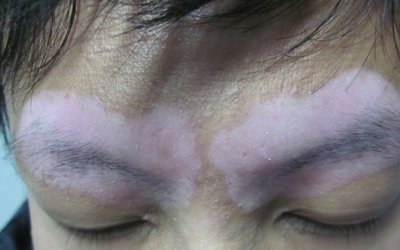 眉毛长白癜风初期症状图片