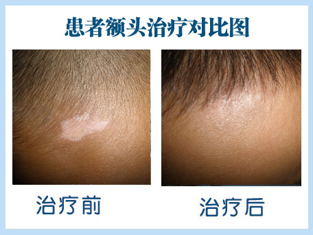 头部有两块一元硬币大小的白癜风好治吗