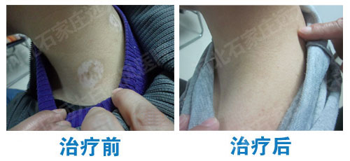 白斑如果是白癜风能治愈吗