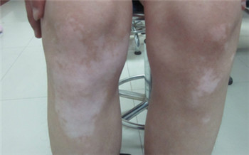 黑色素减少引起的白斑是什么