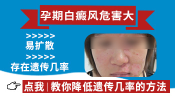 怀孕能检测白癜风基因吗