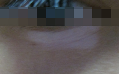 孩子白癜风眼睫毛白了怎么治