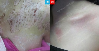 白癜风黑色素移植多少钱