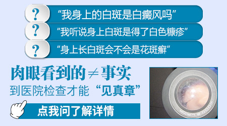 白斑就是白癜风吗 长白斑能治愈吗
