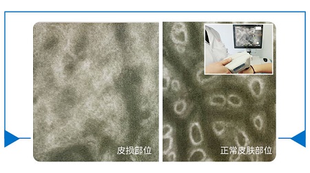 皮肤镜检查白斑多少钱一次
