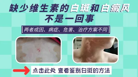 缺乏维生素会导致皮肤长白斑吗