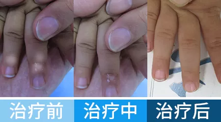 手指白癜风植皮手术后图片