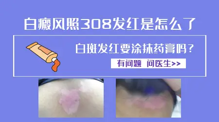 白癜风照308后发红能抹药膏吗