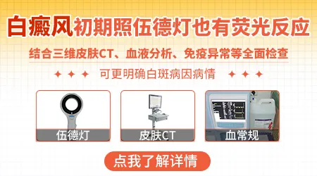 白癜风早期在伍德灯下是否明显