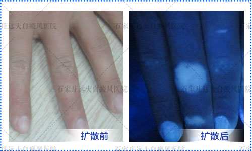 手指顶端白斑有发展一到夏天就扩散