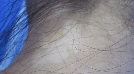 后勃颈有块很白的皮肤是怎么回事