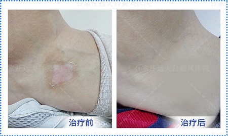 生完孩子得的白癜风会遗传给孩子吗