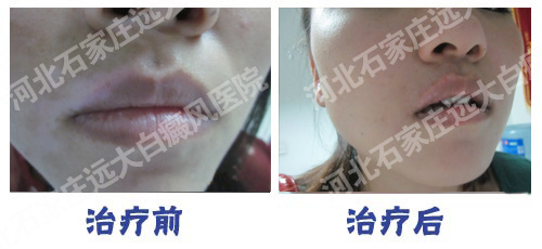 308怎么收费 面部淡白色的白癜风能治好吗