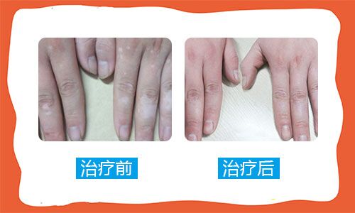 以前一只手有白癜风现在两只手都有了