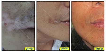 白斑长在嘴角半年多了有什么药能治好吗
