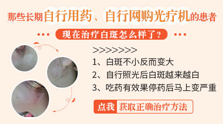 初期白癜风能治好吗