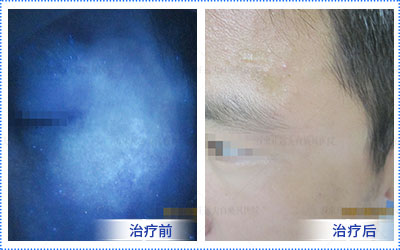 白癜风会几年都没有变化吗