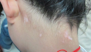 身上有白点现在别的地方又长了一个小白点