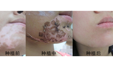 白癜风表皮移植刚拆掉纱布图片