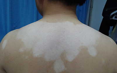 青少年背上有白色的点点图片