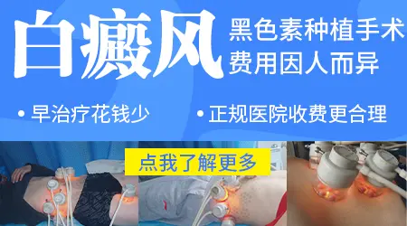 白癜风种植手术费用是按面积算的吗