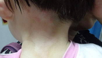 5岁宝宝脖子上出现一个小白斑