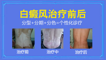 白癜风黑色素细胞移植手术成功率高吗