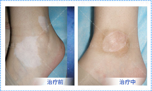 白癜风初期肯定能治好吗 