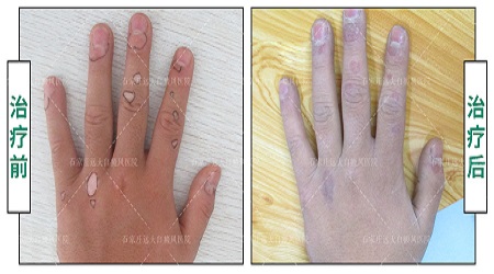 手指关节处皮肤变白什么原因