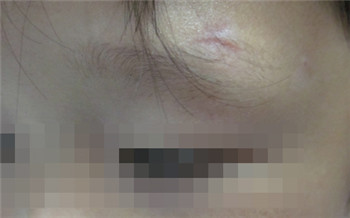 新生儿白癜风早期图片