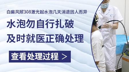 白癜风照光后起小水疱要不要紧