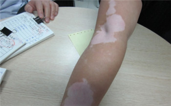 8岁小孩手臂上出现小白点图片