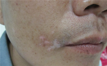 初期白癜风图片的症状表现