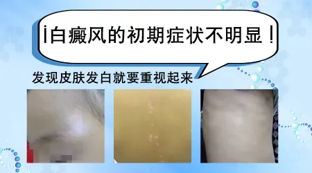 初期白斑怎么判断是不是白癜风