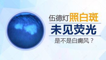 wood灯判断白点是不是白癜风准不准
