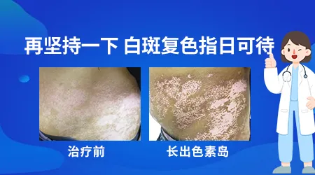 治疗白癜风多久能看到色素岛出现