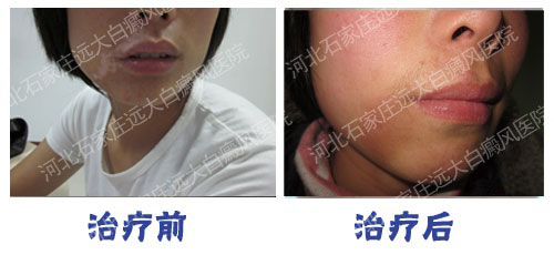 嘴角白癜风初期症状图片