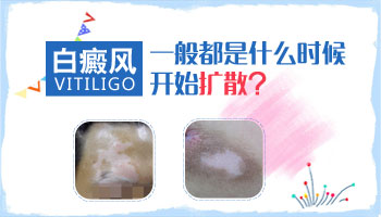 白癜风会扩散到脸上吗