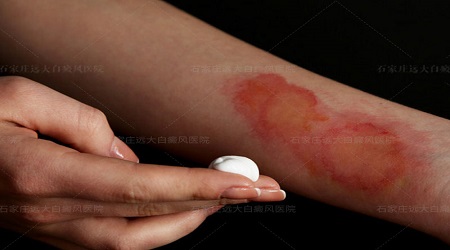 烫伤痊愈后皮肤变白是皮肤病吗