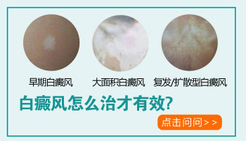 白癜风白斑早期症状图片是什么样子的