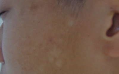 如何判断孩子脸上的白斑是白癜风还是胎记