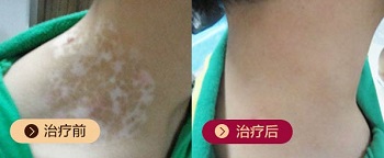 308光疗仪家用什么品牌好