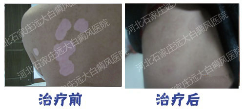 黑细胞移植是植皮吗 能治好白癜风吗